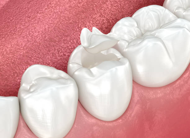 Best Dental Fillings (Composite and Amalgam)  in North Bonneville, WA